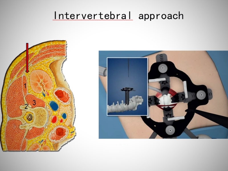 Olomoucký neurochirurg vyvinul unikátní meziobratlový implantát zdroj foto: LF UP Olomouc