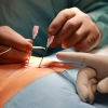 Potíže se střevní inkontinentací může vyřešit neurostimulace